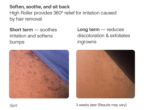 High Roller provides 360º relief for irritation caused by hair removal.