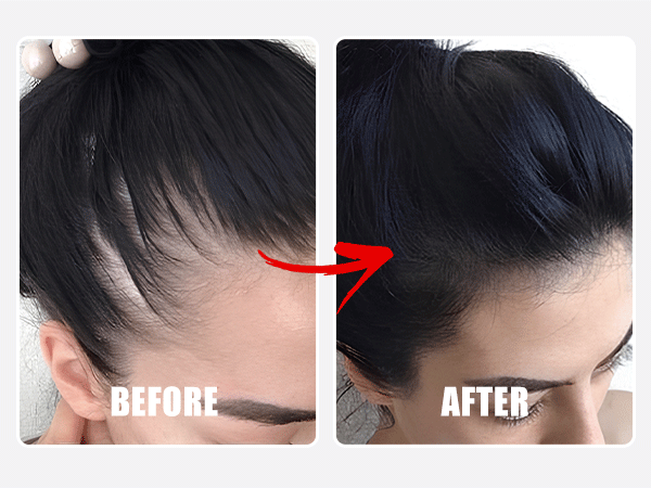 Cover Receding Hairline