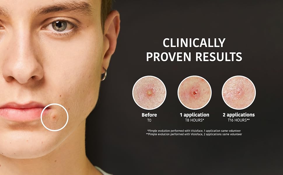 sos-pimple-patches-02