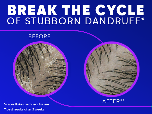 Break the cycle of stubborn dandruff