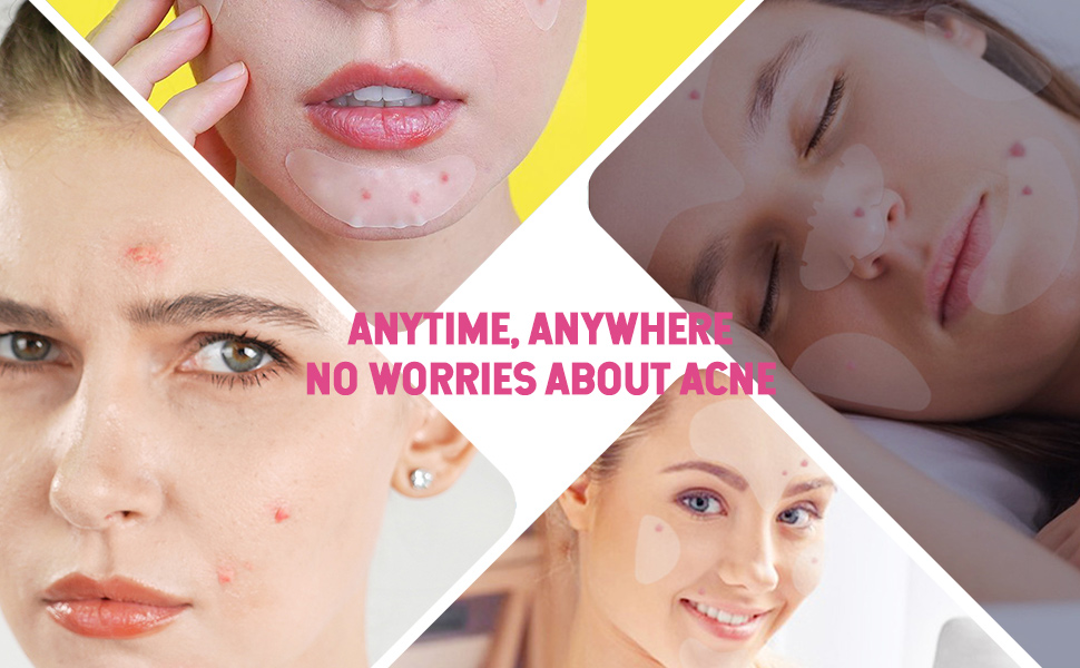 ALTIJD, OVERAL ZORGT OVER ACNE