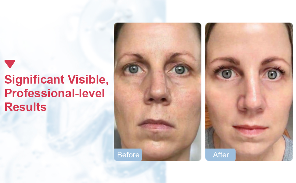 SUNMAY VSkin Radio Frequency Skin Tightening Machine Microcurrent Face