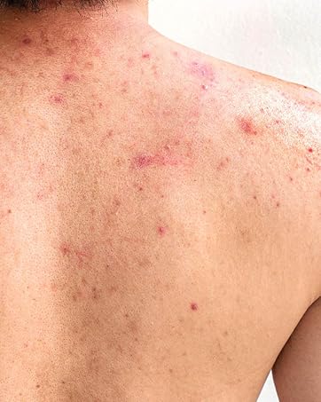 body acne support, back acne support