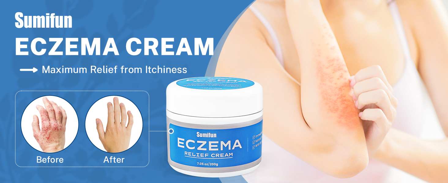Eczema Cream