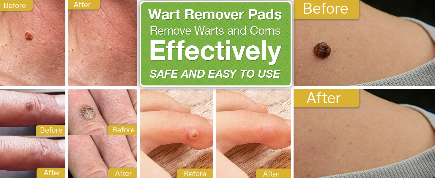 Wart Remover Bandaid FDARegistered Potent Solution for Hands Feet Neck Fingers 12