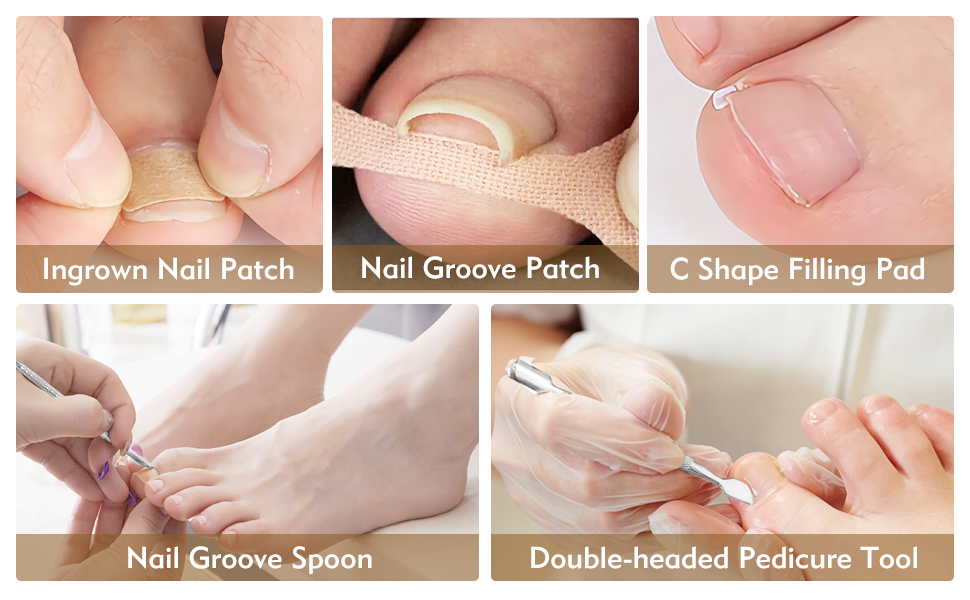 102Pcs Ingrown Toenail Kit, Ingrown Toenail Corrector for Ingrown Toenail Treatment, Including