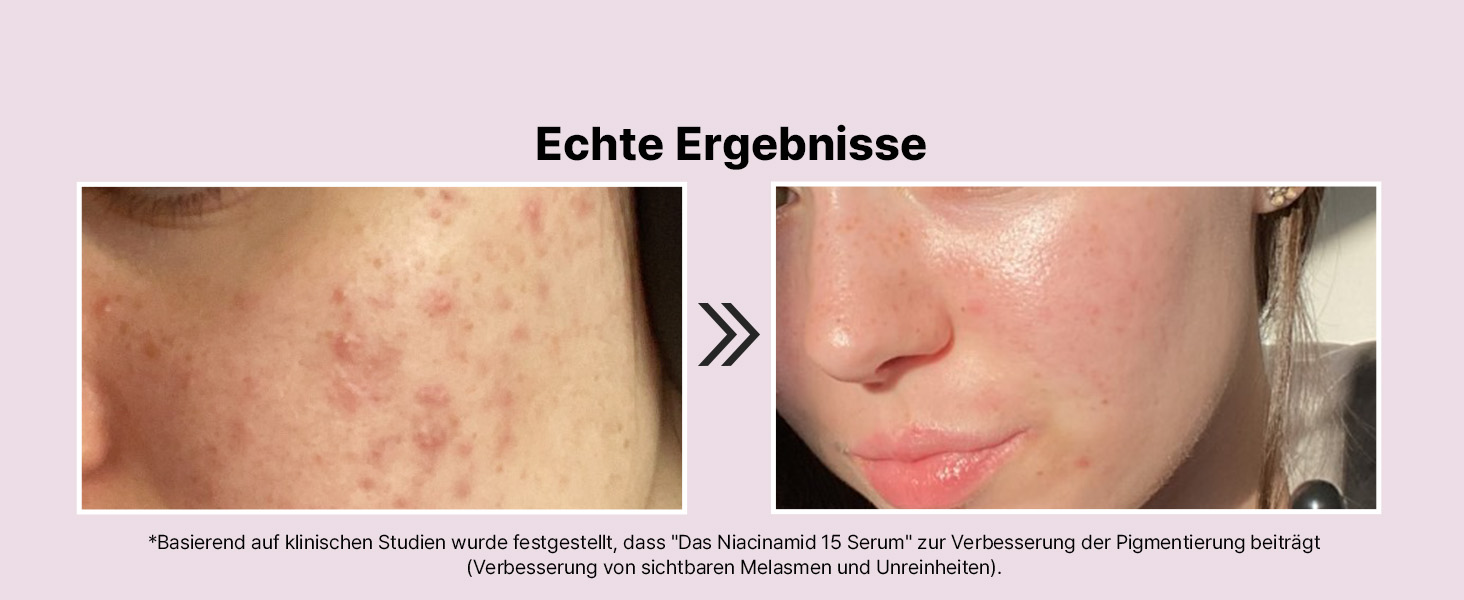 Vergleichsbilder vor und nach der Hautpflege, die eine Verbesserung der Hautstruktur zeigen, mit dem deutschen Text „Echte Ergebnisse“ (Real Results