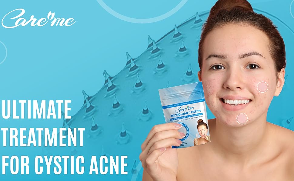 cystic acne treatment