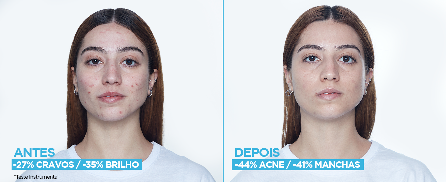 Antes e depois do rosto de uma mulher pós uso do Sérum Antiacne Garnier, com resultados comprovados.