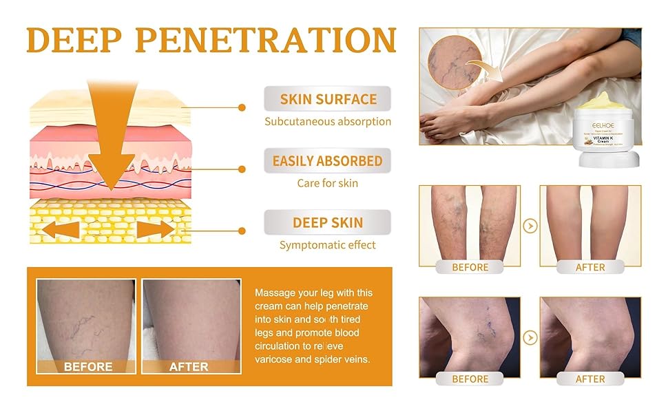 Varicose Veins Cream