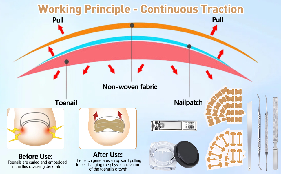 Home-Use Ingrown Toenail Correction Patch Kit, Easy To Use, Reduces Discomfort