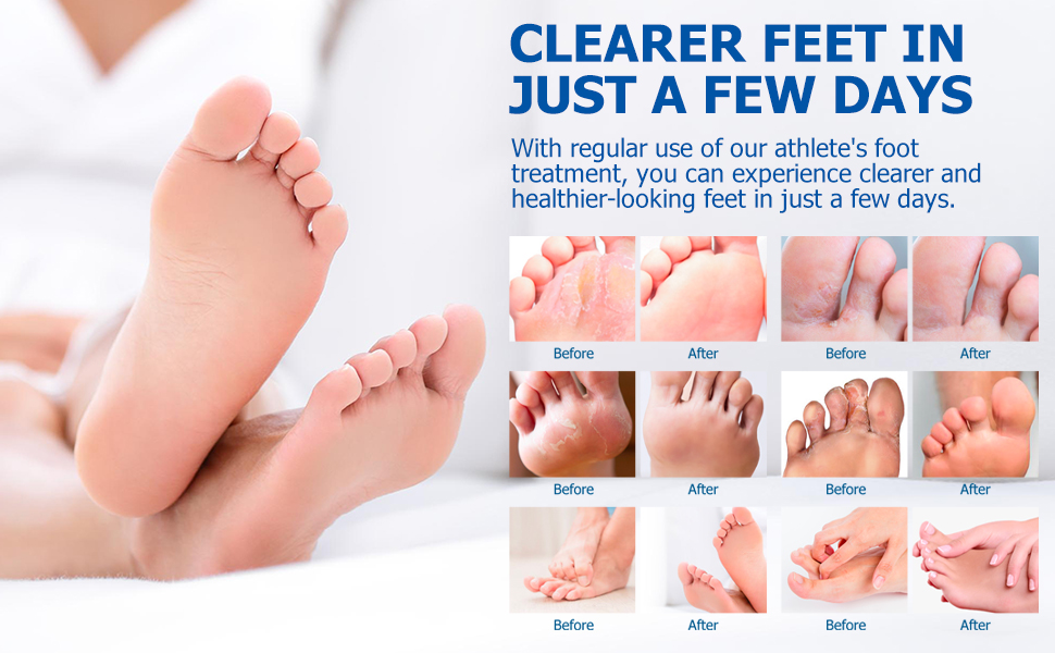 athletes foot treatment