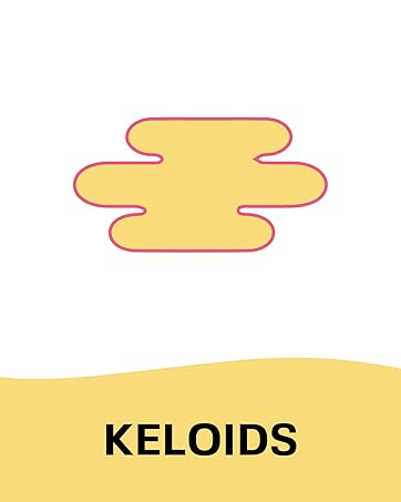keloid treatment removal keloid removal keloid treatment