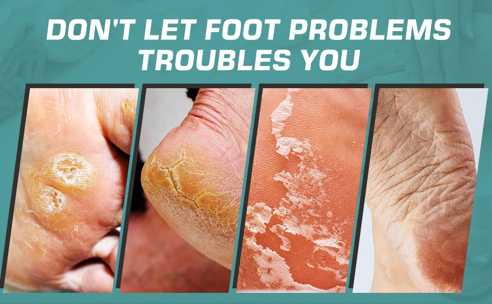  Electric Foot Callus Remover for Feet