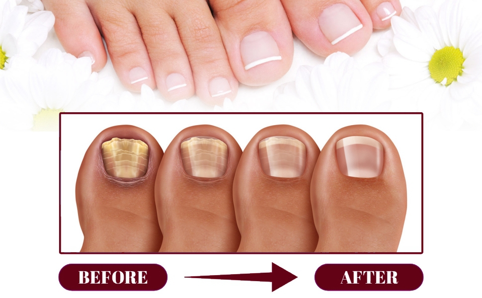 nail repair for damaged nails nail repair oil nail treatment for damaged nails paronychia treatment
