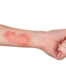 Burn from vegetable oil