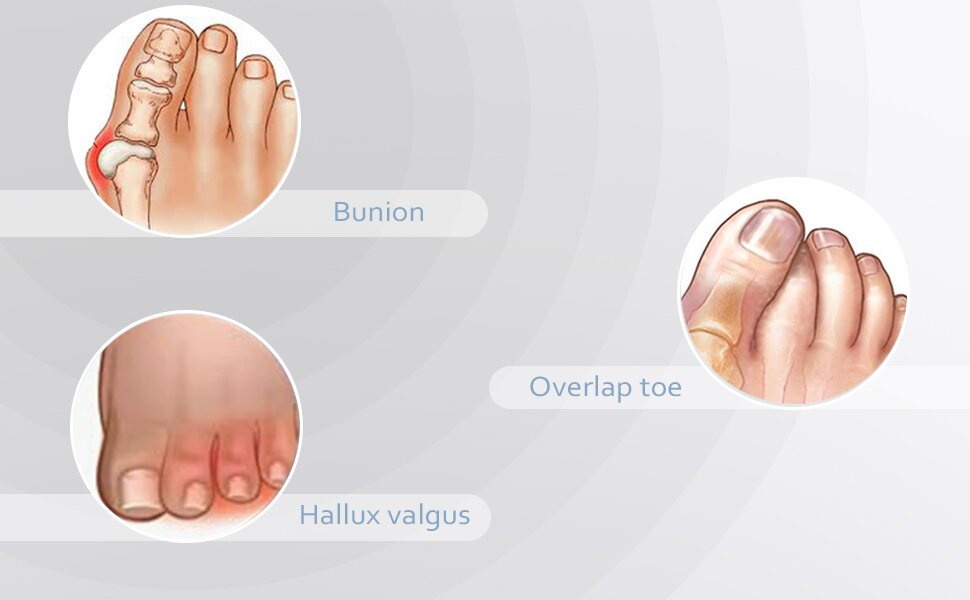 Toe Separators for Overlapping Toes