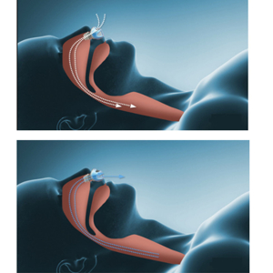 Anti Snoring Devices, Portable Anti Snoring Device
