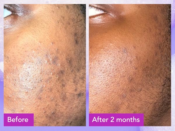 Before and after 2 months