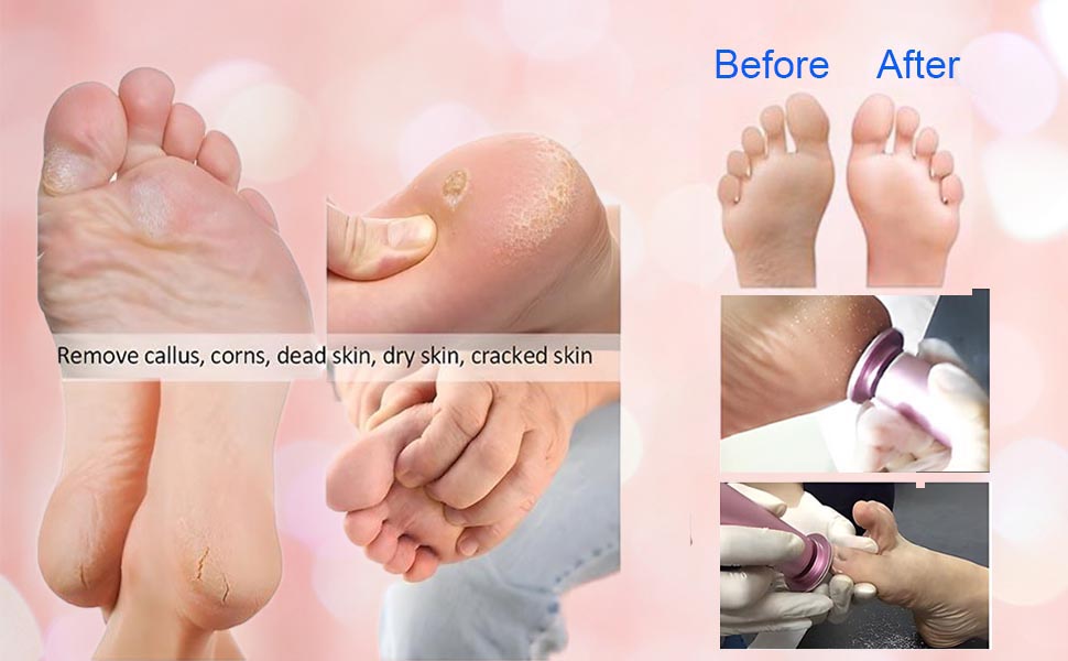 electric callus remover for feet