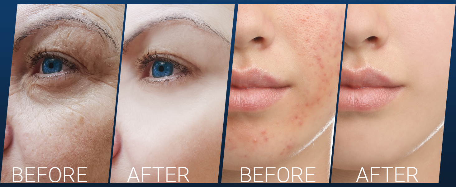 High Frequency Wand UUPAS 6 in 1 Blue High Frequency Facial Machine