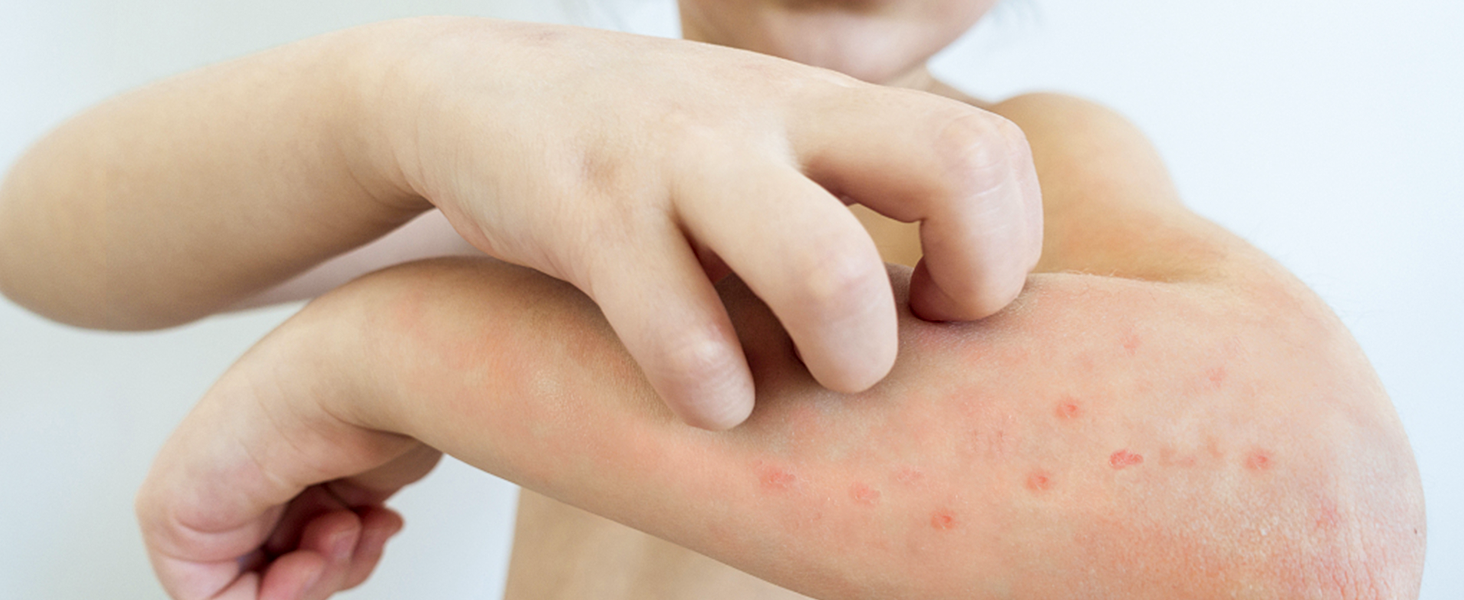 Eczema Cream