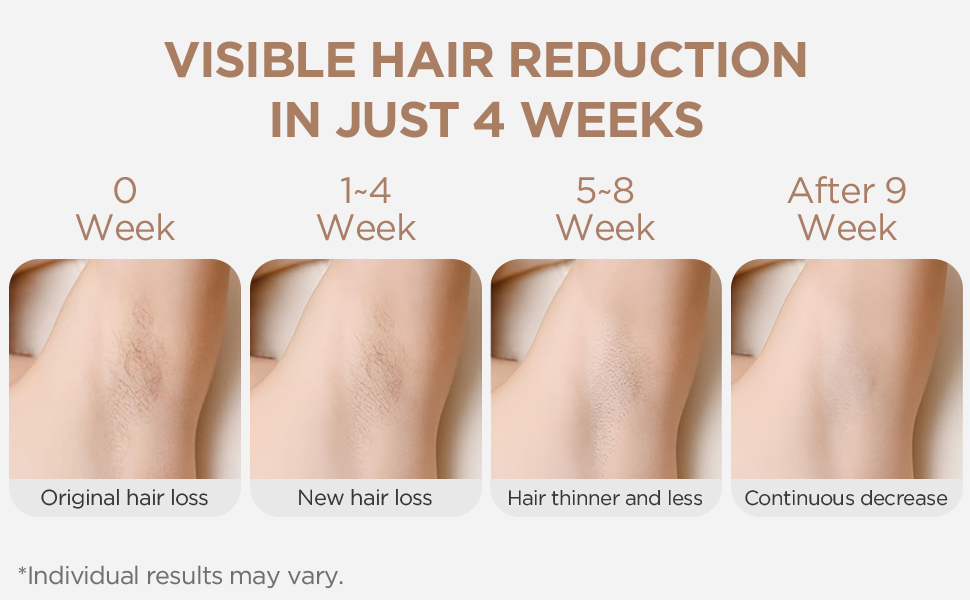 IPL hair removal device