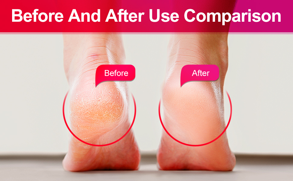 callus remover gel for feet