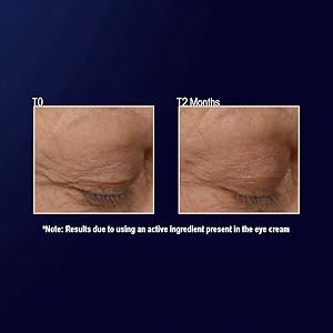 Anora eye cream before and after better than hyaluronic acid 