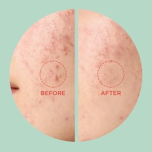 Tea Tree Clear – Dot Patch