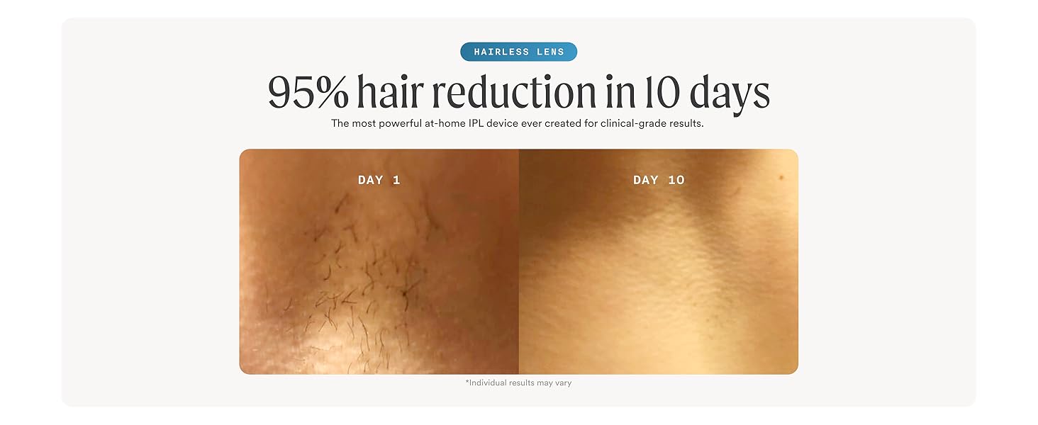 95 percent hair reduction in 10 days