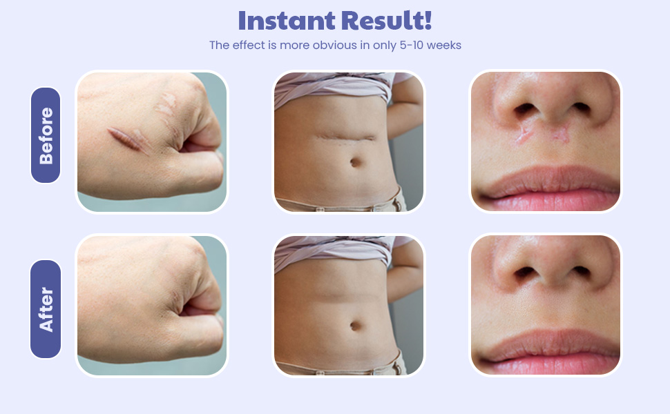 Wipness Silicone Scar Sheets