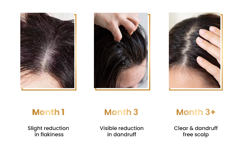 The Skin Story Anti-Dandruff Serum | Clean and Russian-free skulls | Reduces bunch, skull dryness and irritation. Promises healthy hair growth. Saniscalp & Evosina Gp Green | Non-Rasila | All hair types Hair serum for Russian control reduces irritation and supports layer free healthy hair