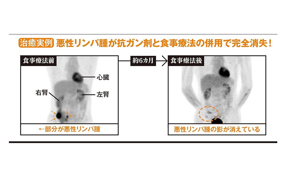 最終値下げ♪ガン患者が最後に選んだ「免疫食」! Amazon.co.jp: がんの消滅：天才医師が挑む光免疫療法 (新潮新書