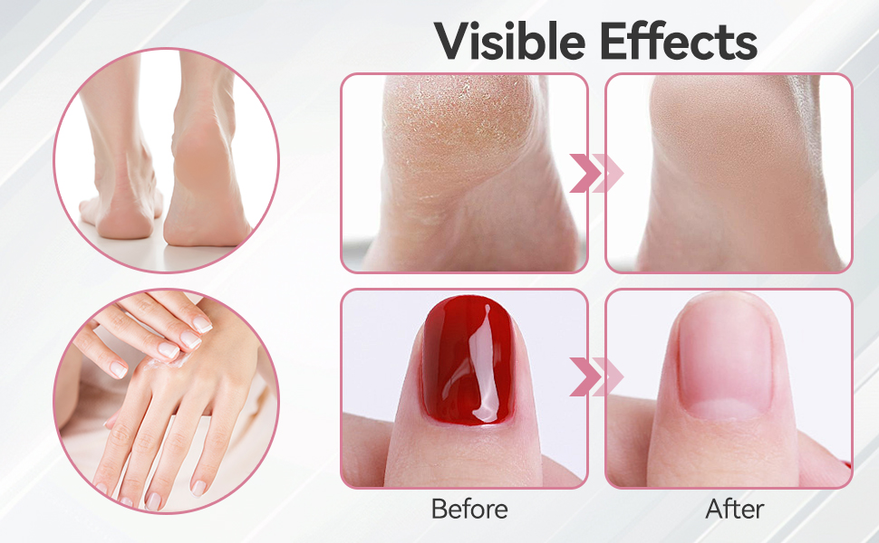 Electric Foot Callus Remover