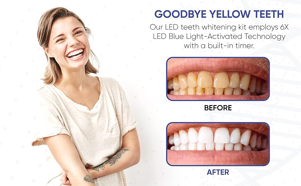 DENTHOTIX LED Teeth Whitening Kit 6X LEDs Sensitivity Free Home Teeth