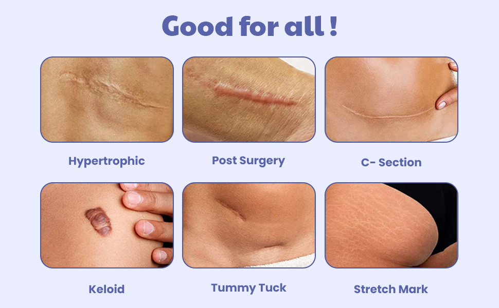 Wipness Silicone Scar Sheets