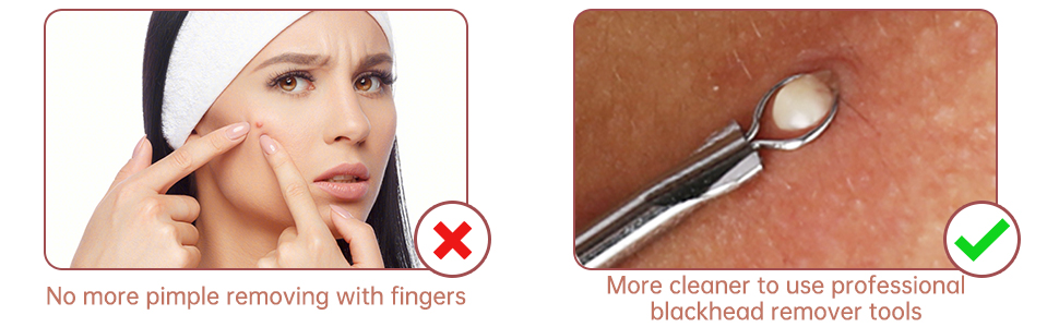 GERY blackhead removal tools