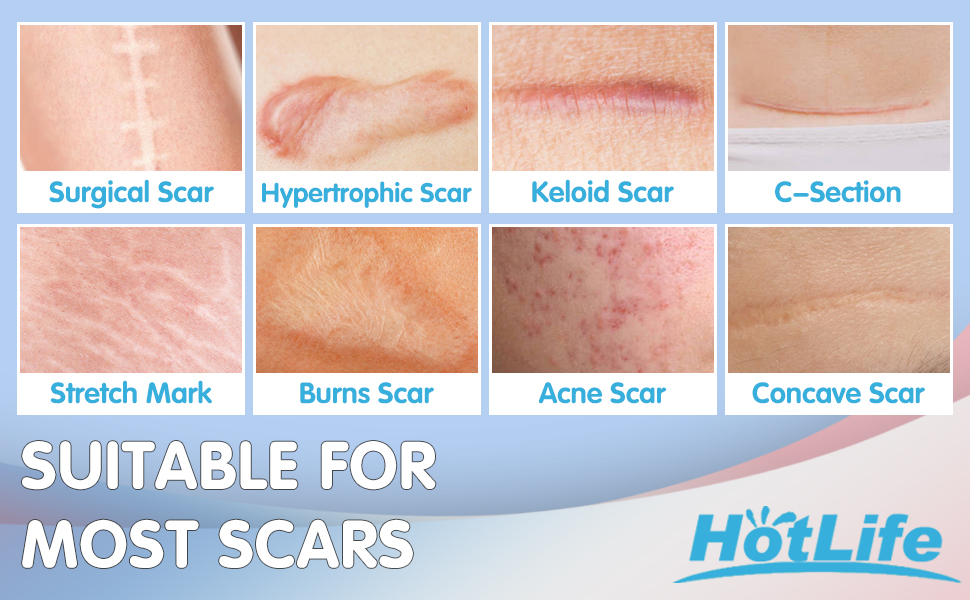 Newst Silicone Scar Sheets 2