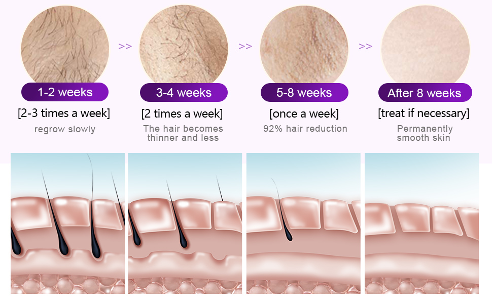 ipl hair removal laser
