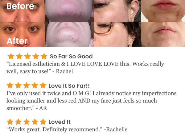 NuDerma Portable Handheld High Frequency Skin Therapy Wand Machine w/Neon – Anti-Aging 