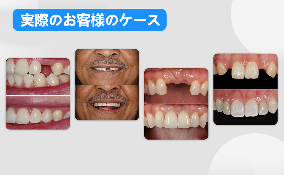Amazon.co.jp: 3本 カスタム 入れ歯 部分 取り外し可能 Dentellea 義歯
