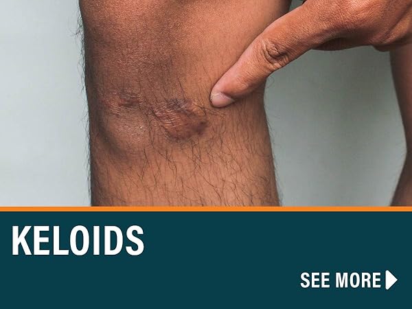 Keloids