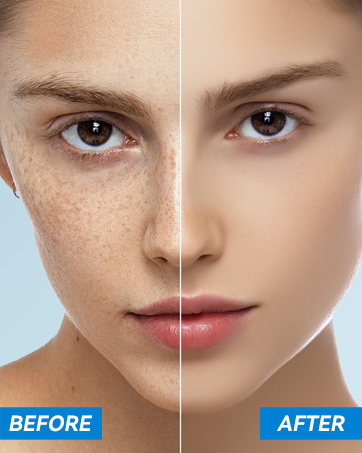 Dark Spot Remover for Face