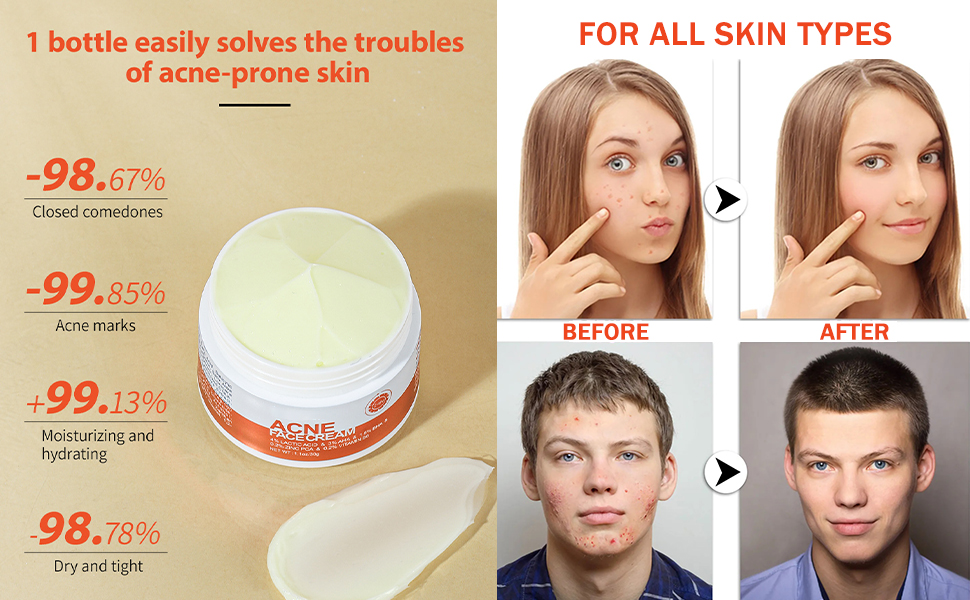 acne face cream