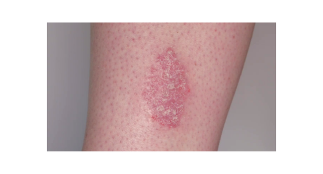 comfrey, recovery, remedy, natural, relief, joint, muscle, rash, ointment