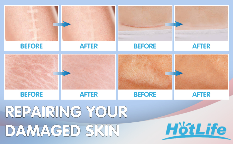 Newst Silicone Scar Sheets 3