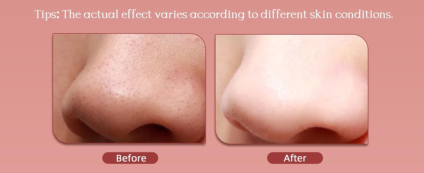 Blackhead Remover