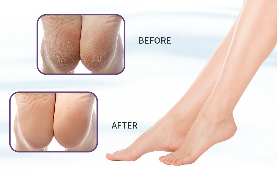 callus removers ped egg for feet pedicure foot rest foot pumice stone foot sander pumis stone feet