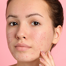 Control Corrective Acne Spot Treatment - woman with acne